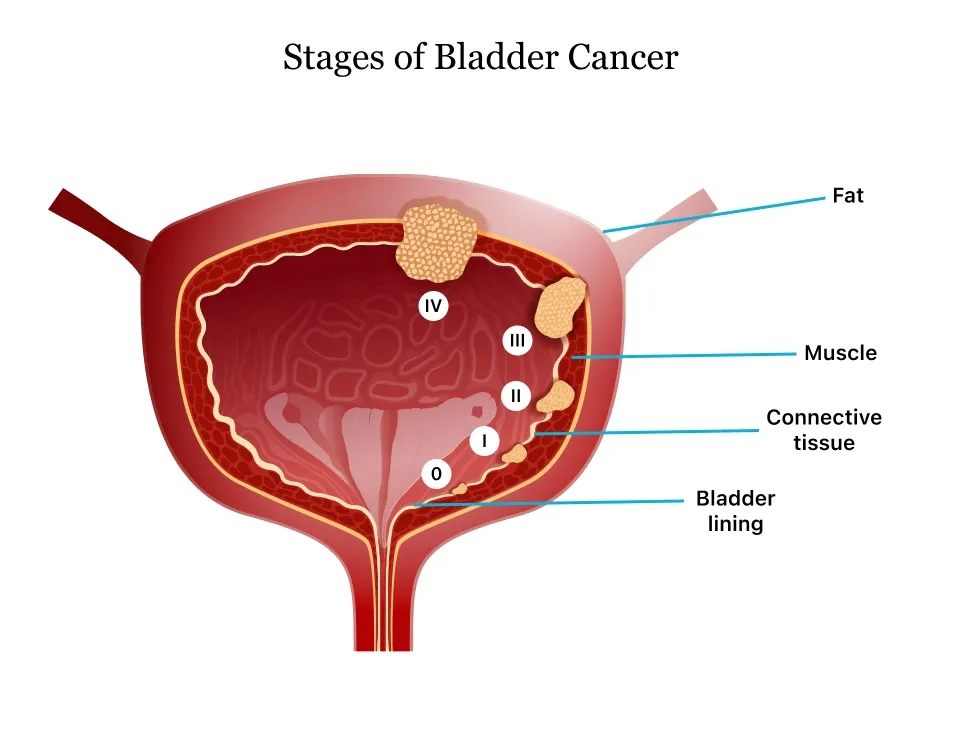 Diagnosis and treatment of bladder (urinary bladder) cancers