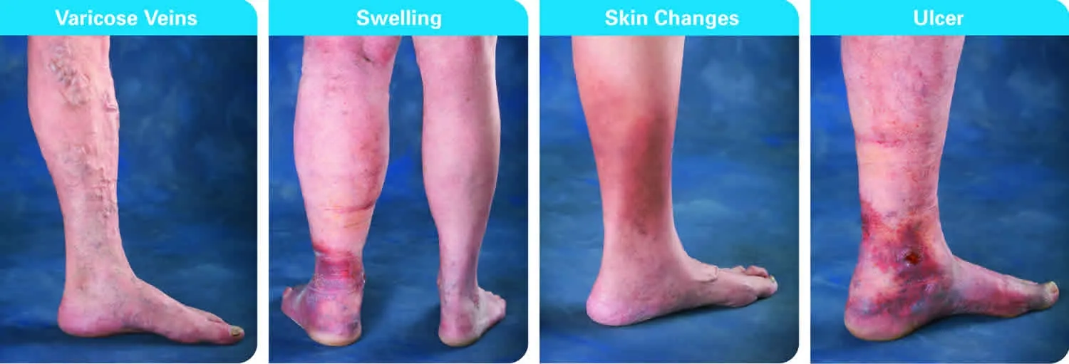 What is venous insufficiency