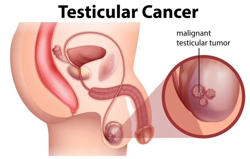 Testicular Cancer and Treatment